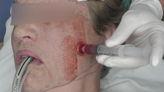 Cosmetic Surgeon Dr. Joe Niamtu uses the CuraCator™