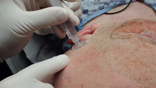 A Physician’s Solution To Messy PRP Facials