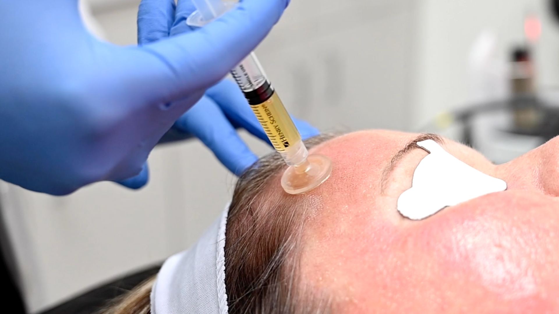 CuraCator™ - Control the Application of PRP