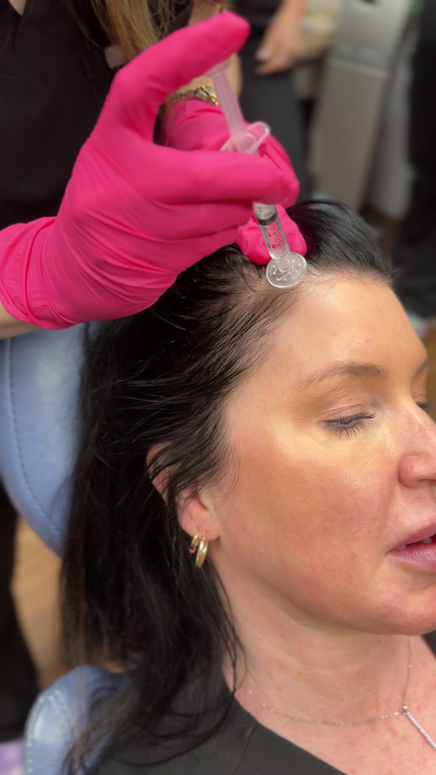 Nurse Practitioner wears a pink glove and applies exosomes on to a patient's hairline using CuraCator™ attached to a Luer-lock syringe. It is applied during a regenerative hair treatment. Patient's hair is black. 